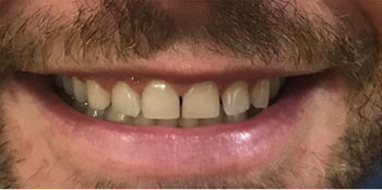 Zoom Teeth Whitening - Before