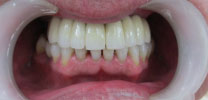 Full Upper Arch Restored With 8 Dental Implants