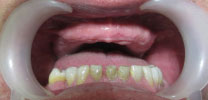Full Upper Arch Restored With 8 Dental Implants