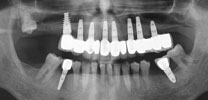 tooth implant cost iran