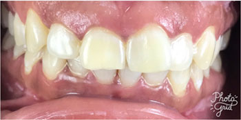 Zoom Teeth Whitening - After