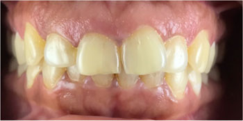 Zoom Teeth Whitening - Before