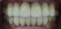 Multiple Lower Front Teeth Restored With 3 Dental Implants