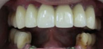 Multiple Lower Front Teeth Restored With 3 Dental Implants