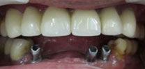 Multiple Lower Front Teeth Restored With 3 Dental Implants