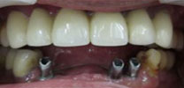 Multiple Lower Front Teeth Restored With 3 Dental Implants in Delhi