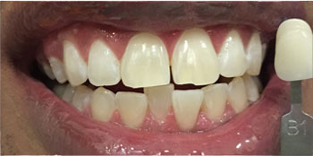 Zoom Teeth Whitening - After