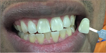 Zoom Teeth Whitening - Before