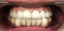 Upper Full Arch Restored With 7 Dental Implants & Malo Bridge in Delhi