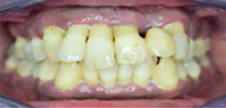 Upper Full Arch Restored With 7 Dental Implants & Malo Bridge