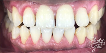 Zoom Teeth Whitening - After