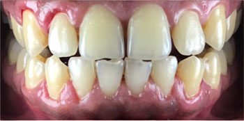 Zoom Teeth Whitening - Before