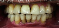 Restored Front Lower Tooth Replaced With Dental Implant