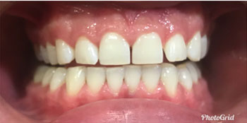 Zoom Teeth Whitening - After