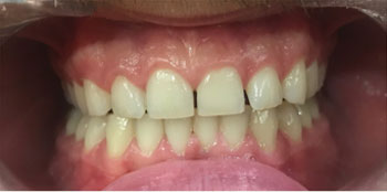 Zoom Teeth Whitening - Before