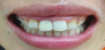 Multiple Upper Front Teeth Restored With Dental Implant in Delhi