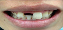 Multiple Upper Front Teeth Restored With Dental Implant
