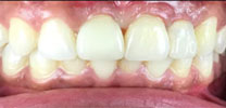 Multiple Missing Front Teeth Restored With Dental Implants