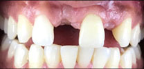 Multiple Missing Front Teeth Restored With Dental Implants