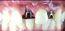 Multiple Missing Front Teeth Restored With Dental Implants