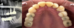 Dental Implants - After