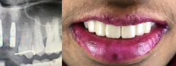Front Teeth Implants - After