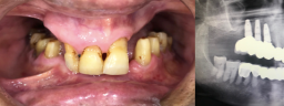 Rehabilitation Dental Implants - Before