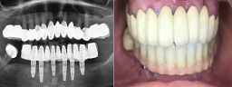 Complete Lower Jaw Rehab with 6 Implants & 12 Units Fixed Teeth (Malo Bridge) - After