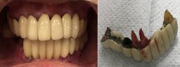 Complete Lower Jaw Rehab with 6 Implants & 12 Units Fixed Teeth (Malo Bridge) - Before