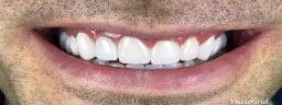 Complete Smile Makeover with Metal Free Crowns - After