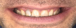 Complete Smile Makeover with Metal Free Crowns - Before