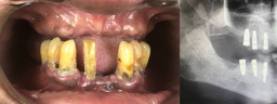 Full Mouth Rehab with Dental Implants & Malo Bridge with Metal Ceramic Crowns - Before