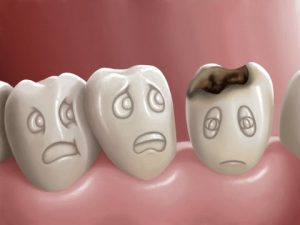 Dental Caries or Cavities