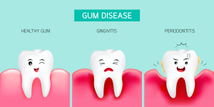 Gingivitis - Periodontitis