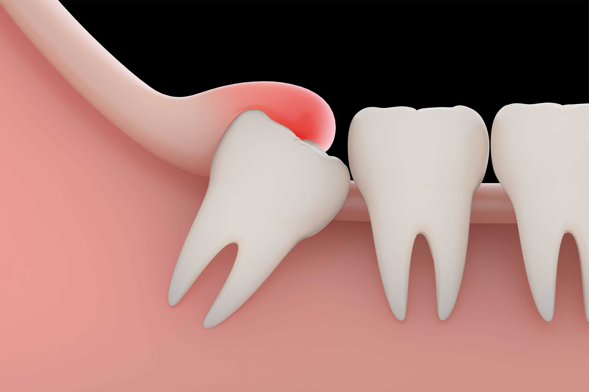 Impacted Wisdom Teeth Removal