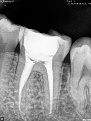 Root Canal Treatment X-Ray taken @ New Delhi Dental Clinic
