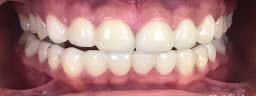 Gap Closure done with Metal Free Crowns in Both Upper and Lower Arches - After