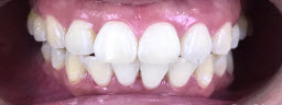 Zoom Teeth Whitening - After