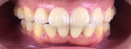 Zoom Teeth Whitening - Before