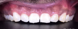 Zoom Teeth Whitening - After