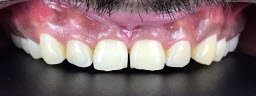 Zoom Whitening - Before