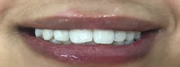 Zoom Whitening - After