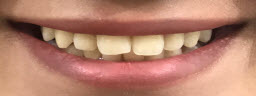 Zoom Teeth Whitening - Before