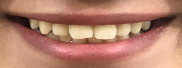 Zoom Whitening - Before