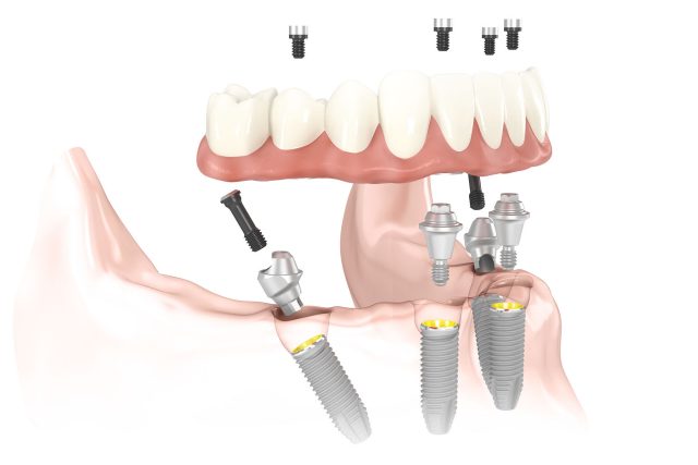 Guided Implant Surgery