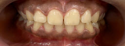 45 Minutes Instant Zoom Teeth Whitening - Before
