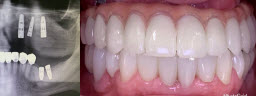 Full mouth rehabilitation with Dental Implants and Metal Free Crowns - After