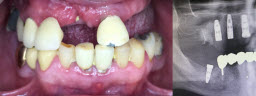 Full mouth rehabilitation with Dental Implants and Metal Free Crowns - Before