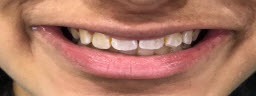 Smile Makeover with instant Zoom Whitening and porcelain veneers - Before