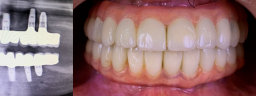 Full Mouth Rehabilitation - After